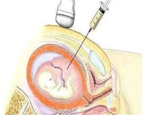 试管之慢性子宫内膜炎